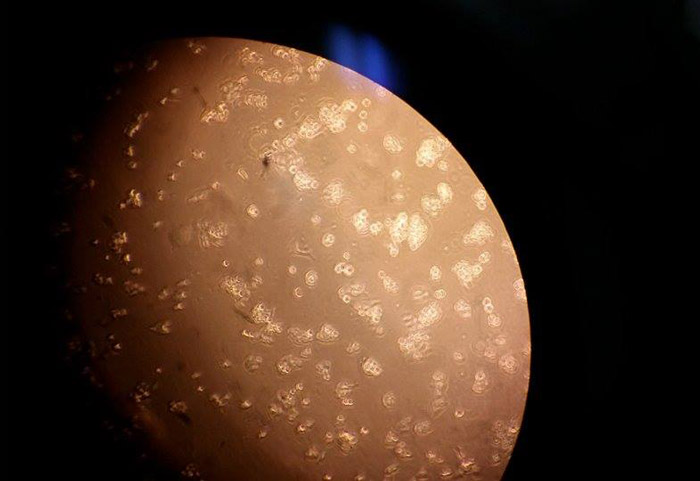 Celulas cancerigenas desde microscopio