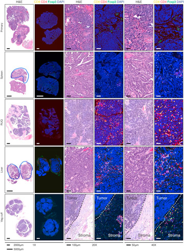 Figura cortes de tumores en color las celulas del sistema inmune