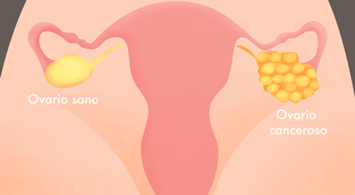 ovario canceroso vs ovario sano0